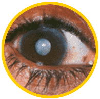 cataract_examinations_img
